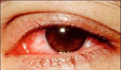 Hà Nội: Bùng phát dịch đau mắt đỏ