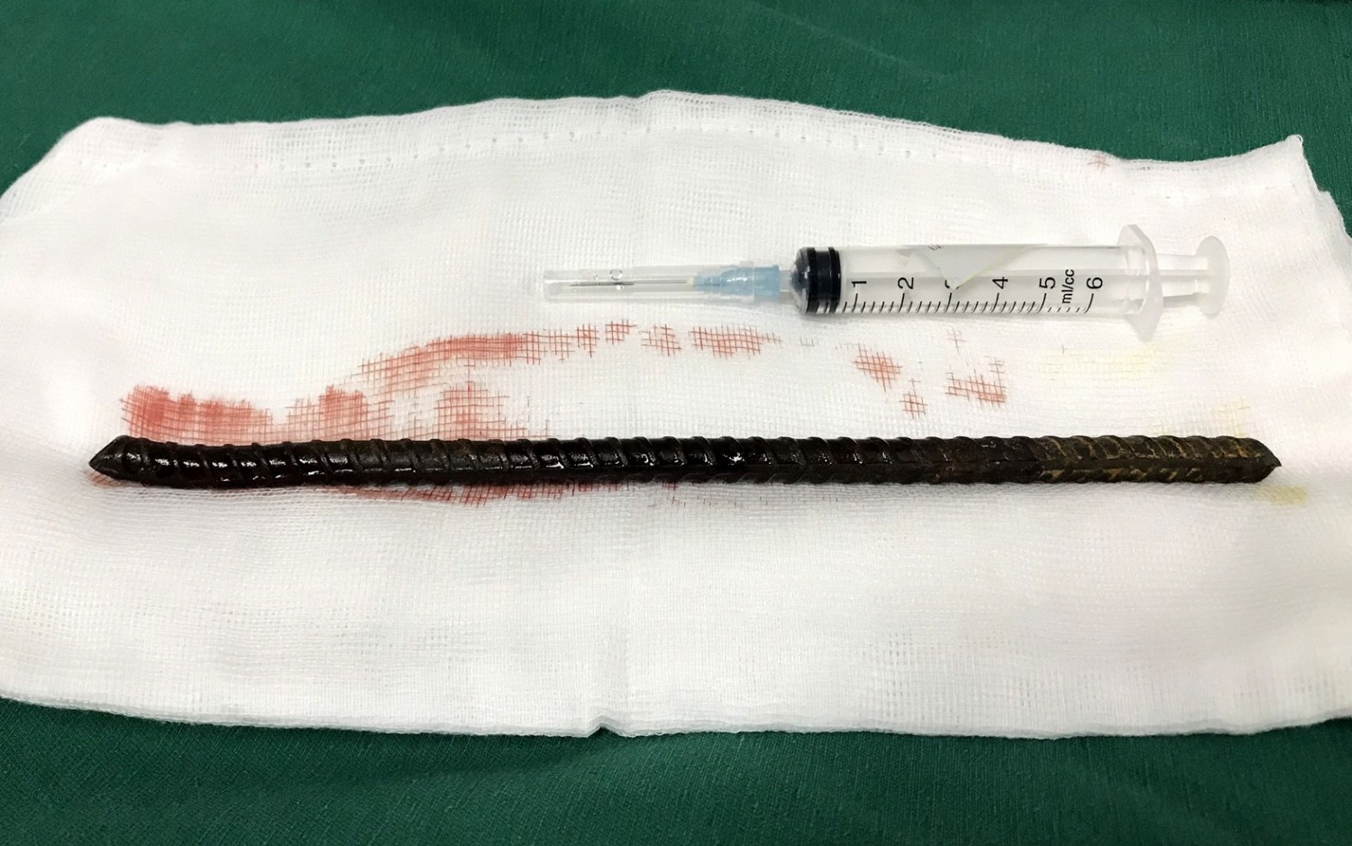 Cấp cứu: nam bệnh nhân bị thanh sắt xuyên thấu đùi bụng