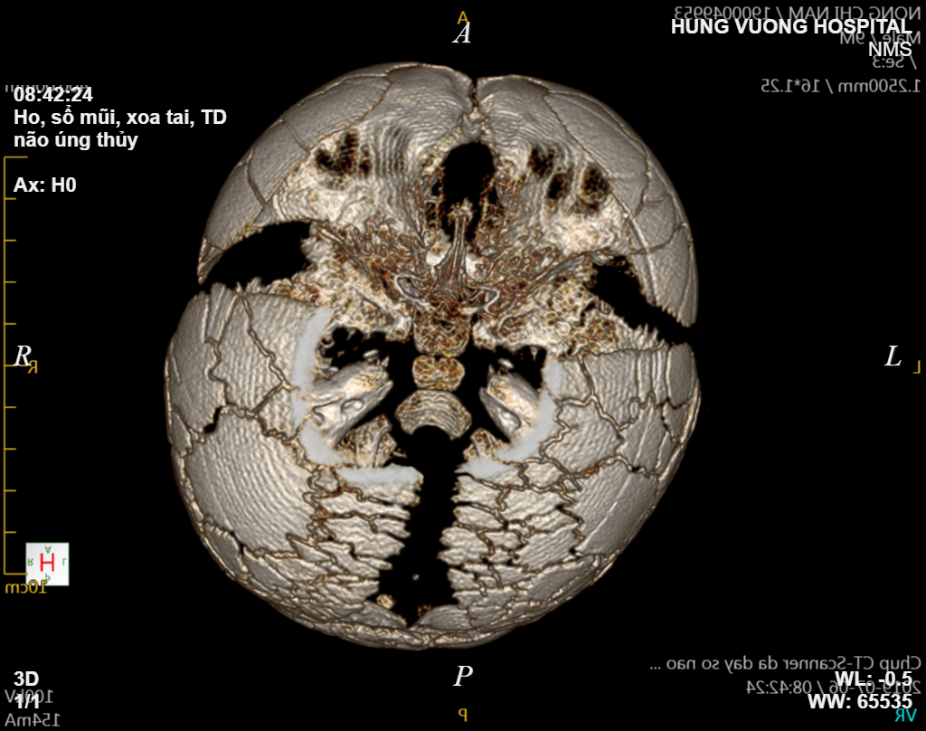 Hình ảnh dựng 3D kết quả CT sọ não của bé.