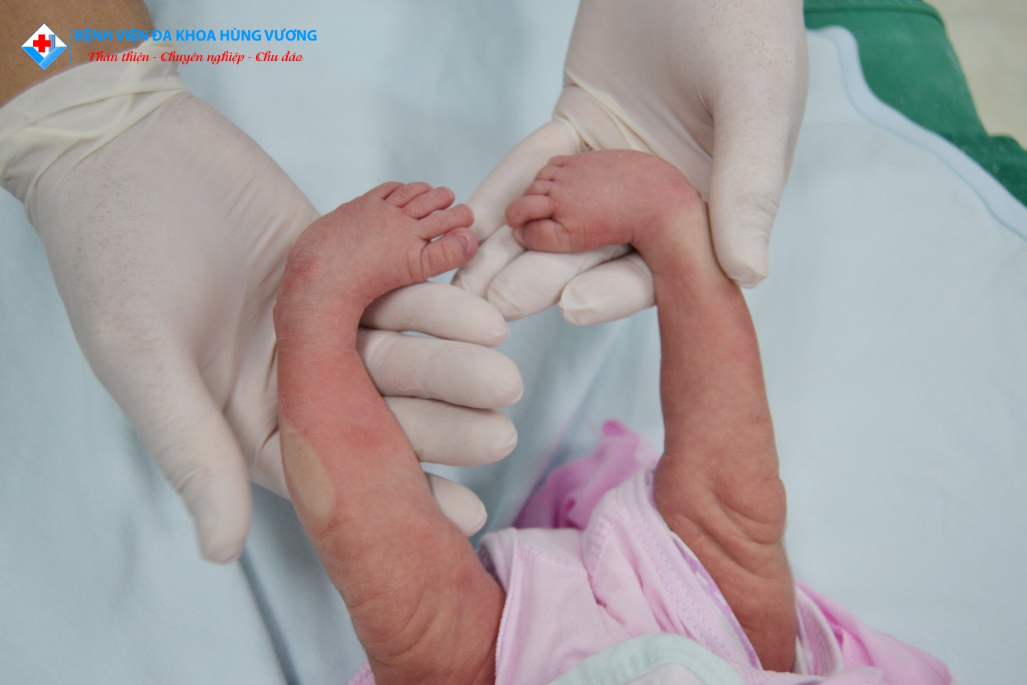 Phục hồi chức năng bàn chân khoèo bẩm sinh cho bé sơ sinh 3 ngày tuổi