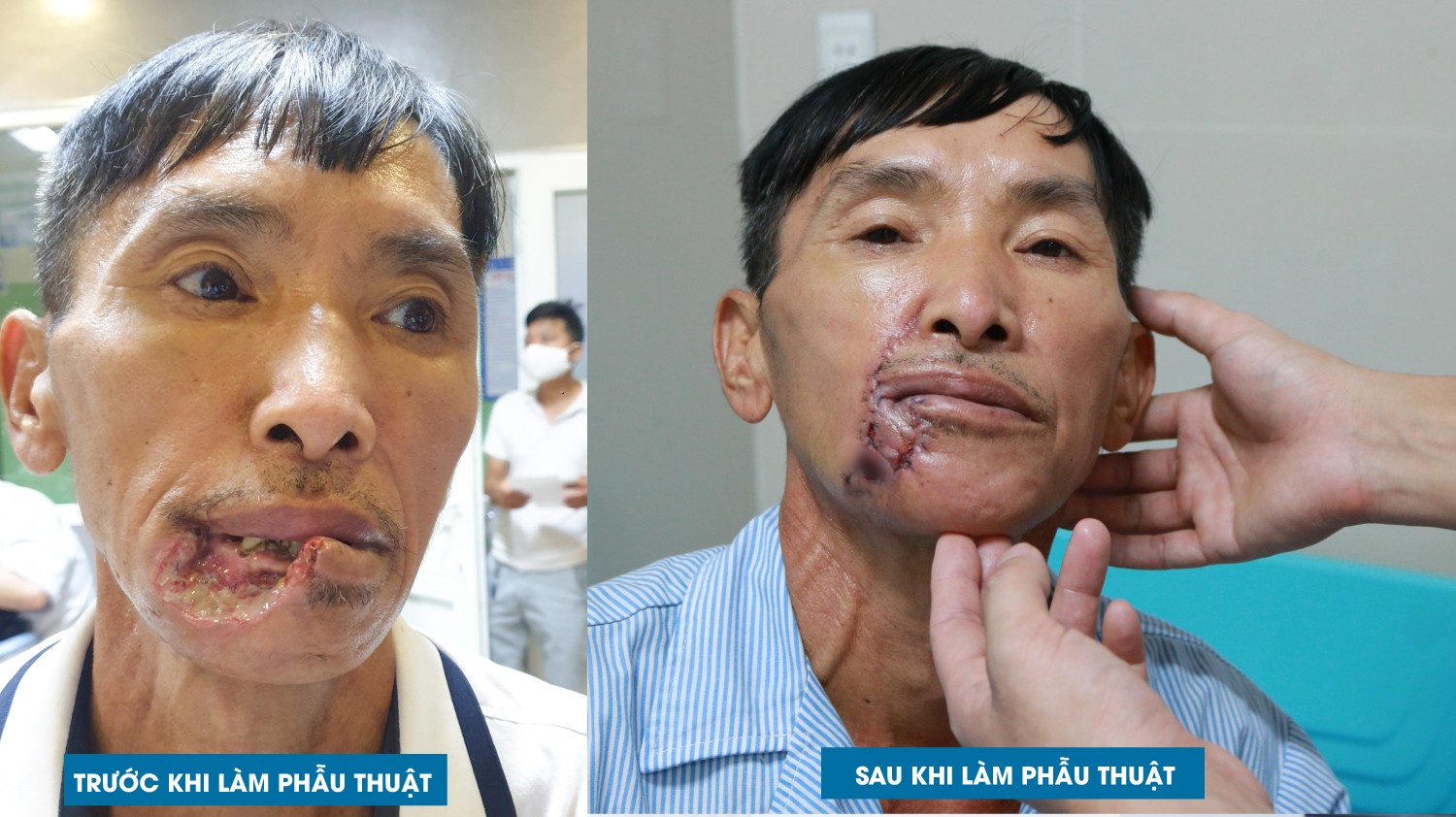 Phẫu thuật tạo hình vi phẫu chuyển vạt che khuyết hổng vùng đầu mặt cổ tại khoa Liên chuyên khoa – Bệnh viện đa khoa Hùng Vương