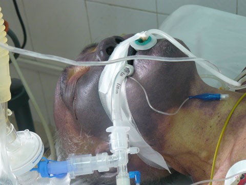 Bệnh nhân bị nhiễm liên cầu khuẩn điều trị tại BV Nhiệt đới TW.